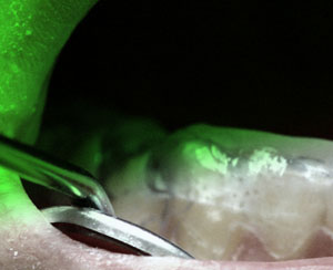 Aufbissschiene im Mund