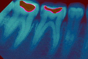 Digitales Röntgen beim Zahnarzt in Berlin-Lichterfelde