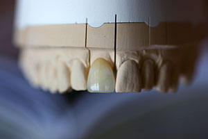 Veneer - hauchdünne, lichtdurch­lässige Keramikschale