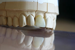 Veneer - hauchdünne, lichtdurch­lässige Keramikschale