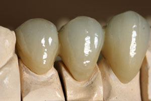 Vollkeramische Kronen 